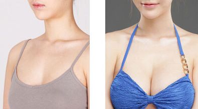 大連李爽矯治專家：隱形矯治、金屬托槽哪家好！