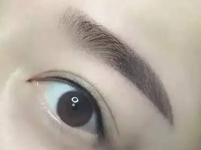 蘇州圣愛醫(yī)院整形科：90天變化揭示，雙眼皮驚喜盡顯！