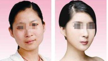 大連附屬二院美容科恢復(fù)效果實(shí)拍，價格揭秘