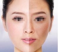 劉志剛醫(yī)生雙眼皮手術(shù)效果怎么樣？