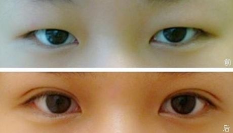上海九院雙眼皮手術(shù)效果怎么樣？錢云良醫(yī)師的全新案例分享