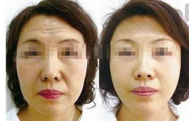 四川人民醫(yī)院王佳醫(yī)生提供下頜角整形案例，讓你輕松擁有小V臉