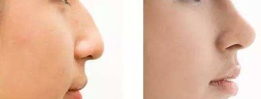 【2023】成都八大處田孝臣隆鼻案例揭秘，鼻部改善效果大躍進(jìn)！