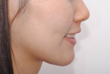 溫醫(yī)大附二院整形科鼻綜合修復(fù)效果可信賴嗎？徐海艇醫(yī)生的豐富經(jīng)驗是否值得信賴呢？