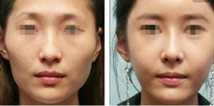 成都最佳雙眼皮修復醫(yī)院推薦，信譽口碑好的五家專業(yè)機構