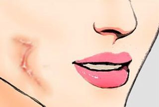 三亞心夢醫(yī)學(xué)劉濤醫(yī)生揭秘，無創(chuàng)吸脂實(shí)踐案例分享及收費(fèi)解析！