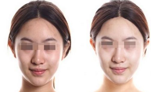 武漢皮膚科祛斑治療效果好在哪？名醫(yī)推薦+祛斑真實案例分享