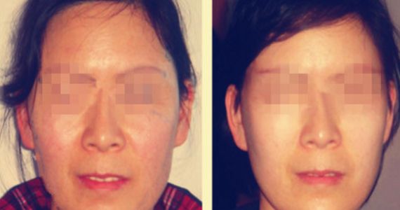 吉林地區(qū)哪家醫(yī)院的雙眼皮手術(shù)效果好