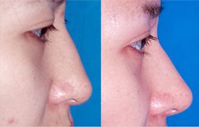 莆田黃金射頻微針去妊娠紋：2023年醫(yī)院排行榜全新公開(kāi)，這家醫(yī)院專業(yè)正規(guī)！