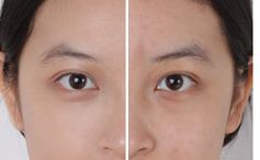 北京301醫(yī)院祛除眼袋方法揭秘，2023真實(shí)案例曝光！