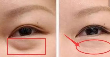 上海楊亞益雙眼皮修復(fù)技術(shù)解析，案例分享全文解讀