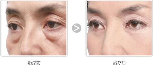 長沙哪家醫(yī)院做隆胸好？專家推薦！