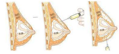 深圳肖東興醫(yī)生雙眼皮手術(shù)出色，讓你煥然一新！80天前的成功案例重磅揭曉！