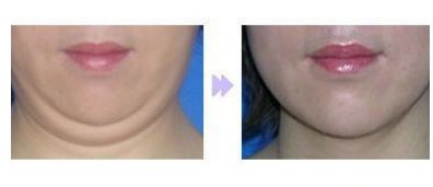 成都友誼醫(yī)院整形科優(yōu)秀醫(yī)師推薦：全臉脂肪填充效果如何？