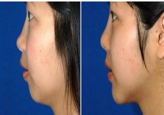 長春銘醫(yī)整形注射哪位醫(yī)師技術(shù)精湛？專家推薦與費用一覽