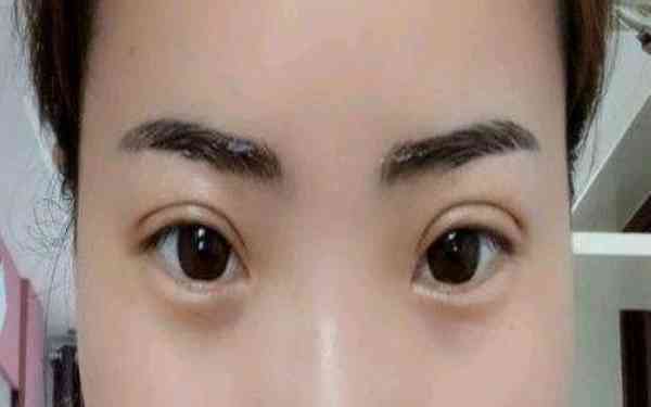 丁硯江填充脂肪的效果如何？為什么該方法備受推崇？