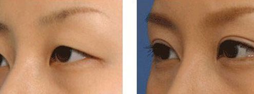 上海九院凸嘴手術(shù)費(fèi)用高昂？手術(shù)技術(shù)如何？推薦醫(yī)生參考