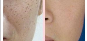 郭金冉面部填充成本公開！醫(yī)生個(gè)人技術(shù)評價(jià)曝光！在線案例展示！