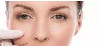 浙醫(yī)二院薛旦雙眼皮效果及價格詳情，醫(yī)生特長與病例分享