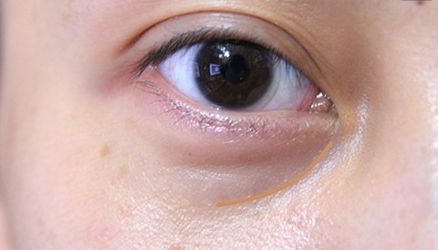 【重慶】銅雀臺雙眼皮醫(yī)生技術(shù)對比，伍森林、王杰醫(yī)、梁海彬誰更厲害？