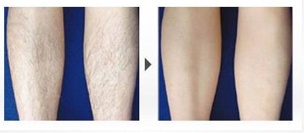 脂肪豐額頭手術(shù)的效果如何？了解專家的分享