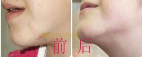 長沙最佳吸脂手術(shù)醫(yī)院排名，雅美、華韓華美、鵬愛等值得借鑒的評價(jià)