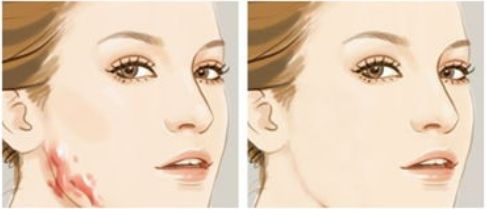 成都光子嫩膚的醫(yī)院選擇有哪些？推薦值得信賴的三甲公立機構！