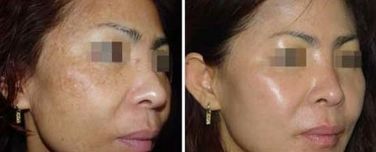 探索誰是脂肪填充領(lǐng)域的專家