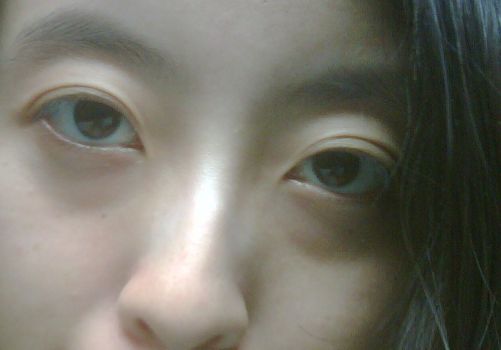 成都高鑫湯勇醫(yī)生_最新脂肪隆胸案例分享