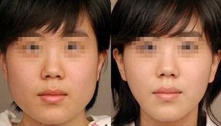 昆明自體脂肪填充專業(yè)醫(yī)院排行榜！獲取數(shù)量前十的醫(yī)療機構(gòu)名單！