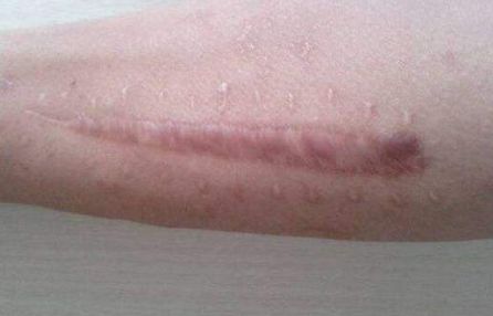 北京藝星白書白師傅，2023獨(dú)家案例揭秘：雙眼皮手術(shù)讓你閃耀美麗！