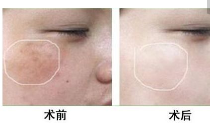 長沙美田芳斌雙眼皮讓你驚艷！令人難忘的改變來襲！