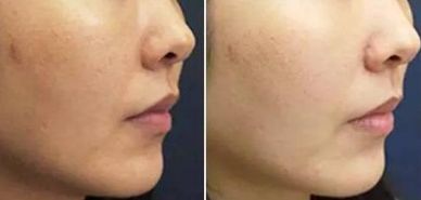 八大處王佳琦醫(yī)生獨(dú)家技術(shù)！驚艷去眼袋，50天展示成果震撼！