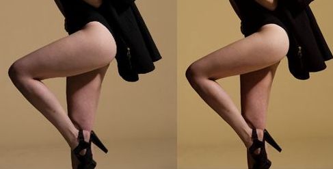 蘭州亞韓整形醫(yī)院的雙眼皮手術(shù)效果如何？親身體驗分享+手術(shù)案例解析