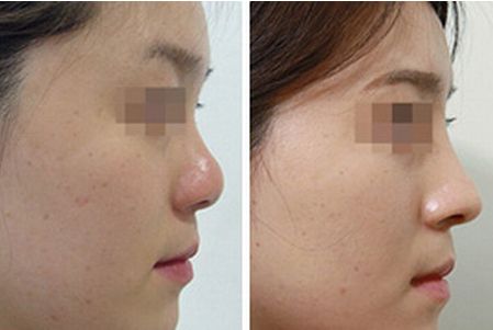 成都哪個醫(yī)生在鼻子整形領域當之無愧！引領潮流的頂級專家盤點