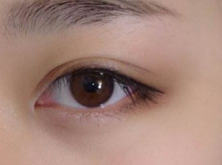 杭州任東做鼻部整容效果如何？MD技術(shù)解析真實案例分享！