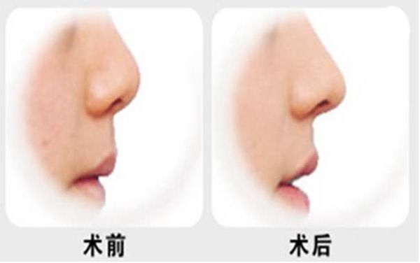 燕雄鼻子整容結(jié)果亮相！專家實(shí)力和成功案例揭秘