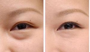 李鴻軍醫(yī)生點評：上?；颊叩谋亲诱谓?jīng)驗分享