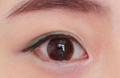 廣州高尚整形美容醫(yī)院隆鼻技術(shù)優(yōu)勢揭秘，80天細節(jié)圖曝光！