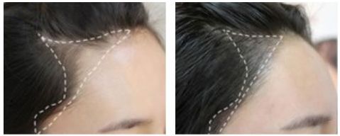 西安丁合軍的鼻子修復(fù)效果如何？90天真實(shí)案例分享