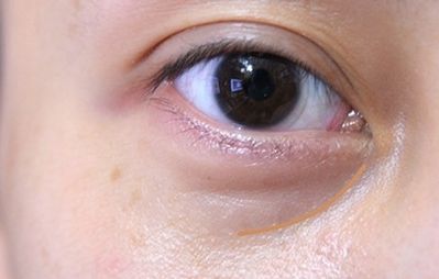 重慶美萊鄭楠醫(yī)生眼部整形術(shù)情況、資料及價(jià)格請(qǐng)參考