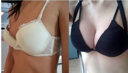 重塑輪廓看陳遠(yuǎn)琨的神奇隆鼻技術(shù)！附案例參考