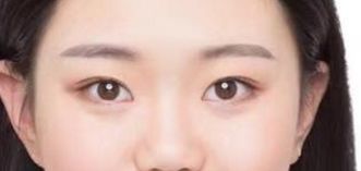 山東省立醫(yī)院整形外科激光祛斑真的有效嗎？