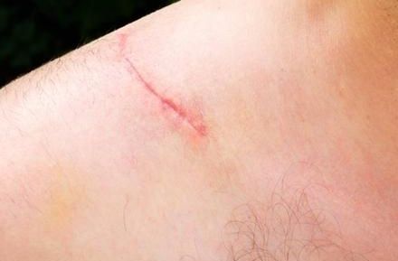 八大處張超面部吸脂效果解析：醫(yī)生技術(shù)實力、案例與價格