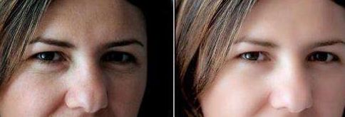 南京塑美顏吳應凱丨鼻部重塑矯正持久效果曝光