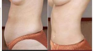 長沙哪家醫(yī)院做隆胸比較好？權威機構助你塑造完美曲線！