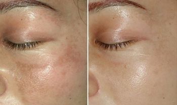 李天石做眼皮手術(shù)費用昂貴？個人體驗分享：三個月改變！