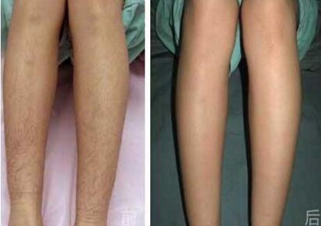 溫州自體脂肪隆鼻哪家醫(yī)院靠譜？熱門醫(yī)院推薦排行榜揭曉！