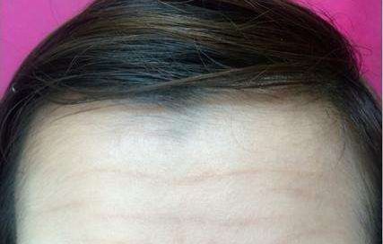 陳金超醫(yī)生高效雙眼皮效果秀！超卓案例展示揭示驚喜效果！