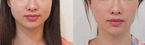 上海宋建星魅力煥發(fā)：脂肪隆胸新技術(shù)引爆美麗革命